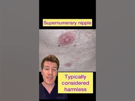 what causes a third nipple|Third Nipple: Incidence, Types, Causes, and Removal